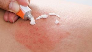 Tác hại của triệt lông vĩnh viễn ít ai để ý tới Copy