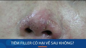 Tiêm filler có hại về sau không? Dấu hiệu và cách xử lý mới nhất 2025